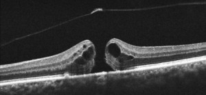 Macular hole OCT scan image