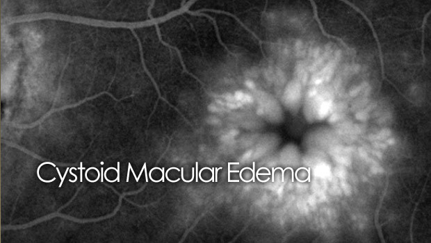 Cystoid Macular Edema CME Swelling In The Macula