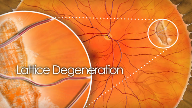 Lattice degeneration causes, treatments and surgery