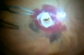 Sub-retinal clot removal