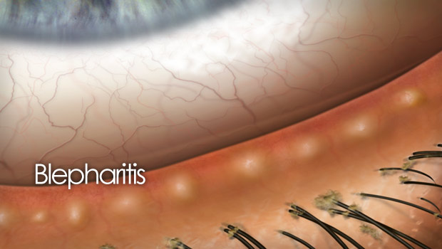 Blepharitis (Eyelid Inflammation): Causes & Treatment