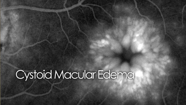 CME - Cystoid macular edema