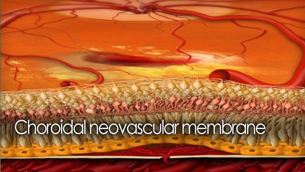 choroidal neovascularization oct