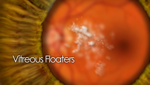 Floaters in the vision