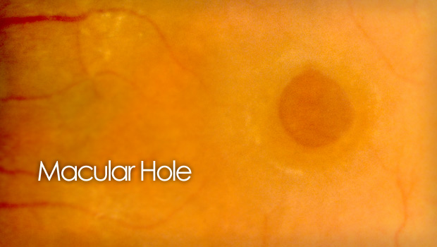 eye scan with hole in retina