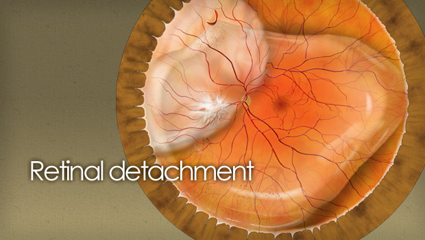 Retinal detachment causes, treatments, news and surgery