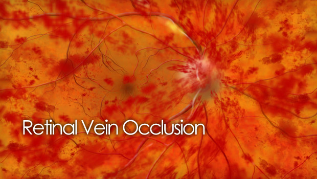 Retinal vein occlusion
