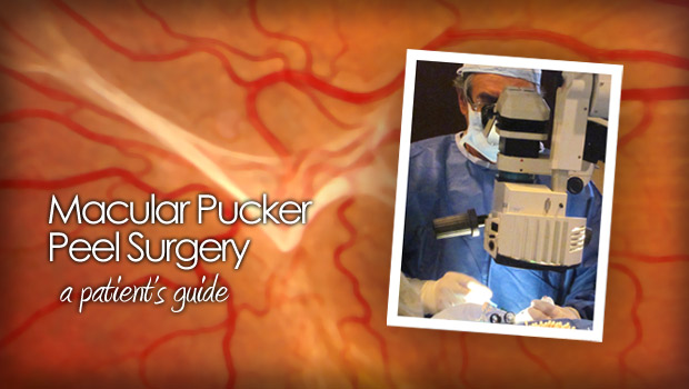 Macular pucker peel surgery photo