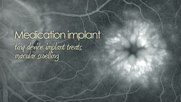 Retisert eye implant for uveitis and cme