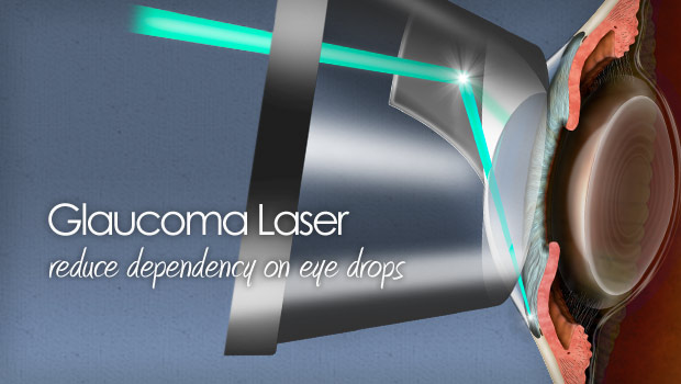 glaucoma laser