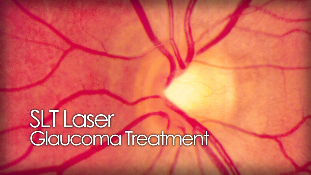 SLT glaucoma laser