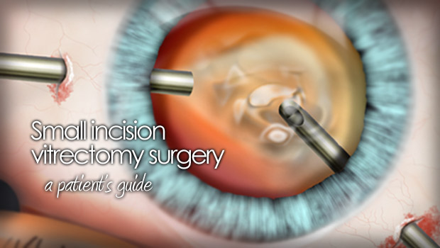 Vitrectomy eye surgery illustration