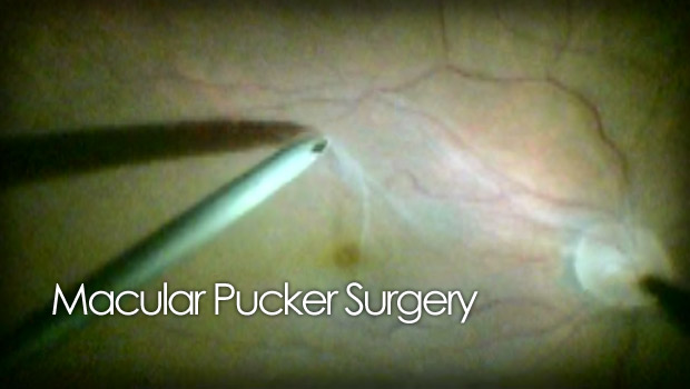 Macular pucker peel surgery video