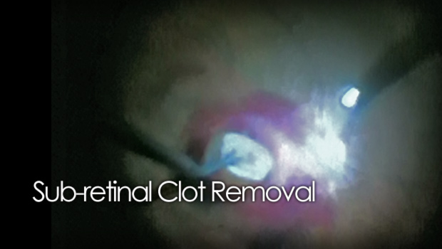 Sub-retinal surgery clot removal