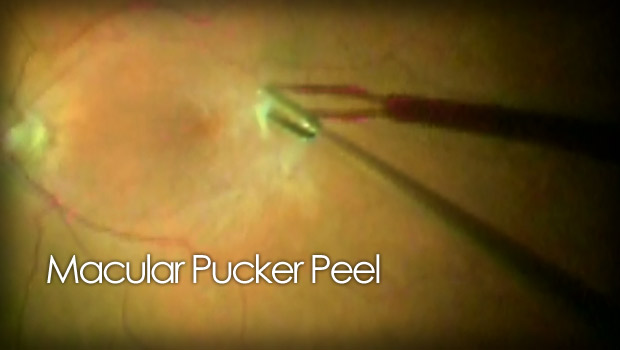 Macular pucker peel surgery video
