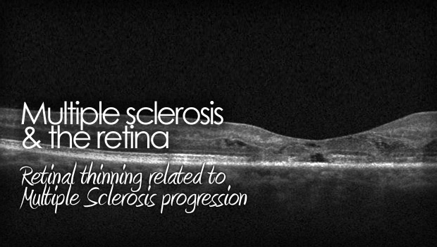The Retinal Thinning And Multiple Sclerosis Connection