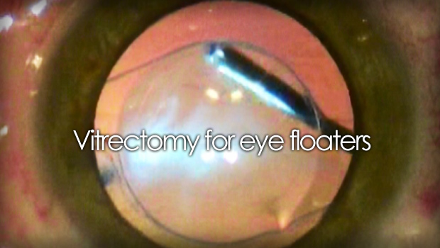 Elimination of eye with vitrectomy surgery