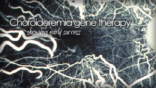Choroideremia gene therapy