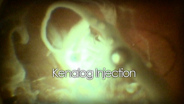 Kenalog eye injection for macular edema