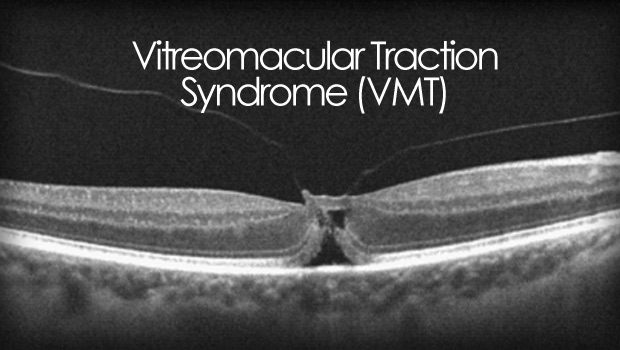 Vitreomacular traction syndrome
