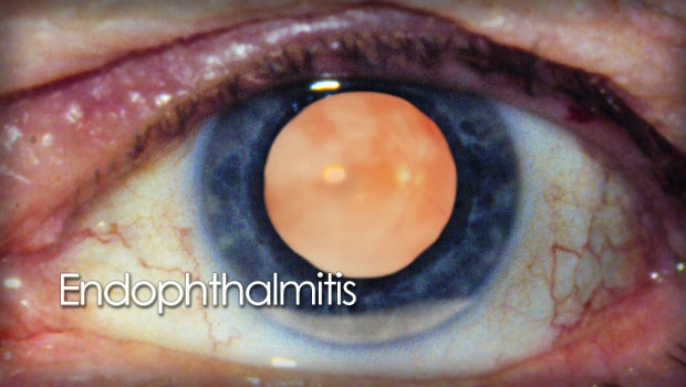 endophthalmitis eye infection
